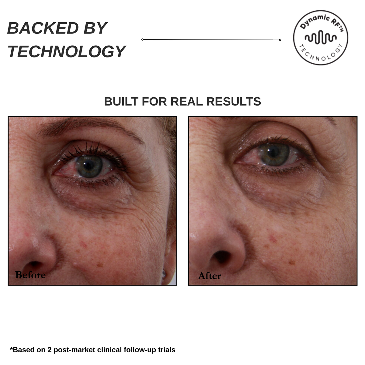 Sensilift Smart RF Skin-Firming