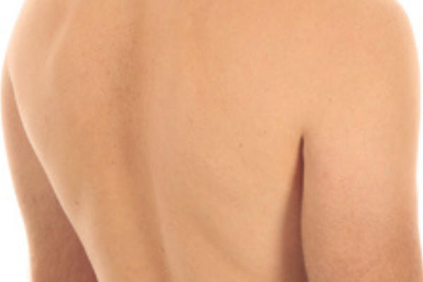 Shoulders & Back - hair removal results — After