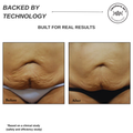 Sensifirm Anti-Cellulite Skin Tightening